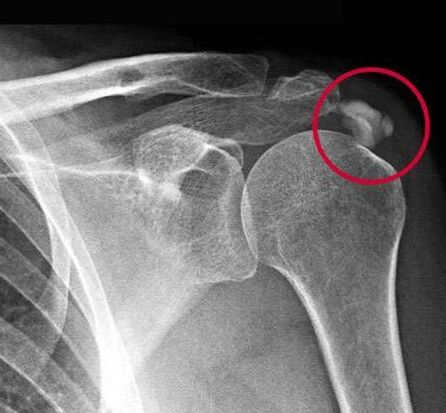 X-rays showed deposits of calcium salts in the joints