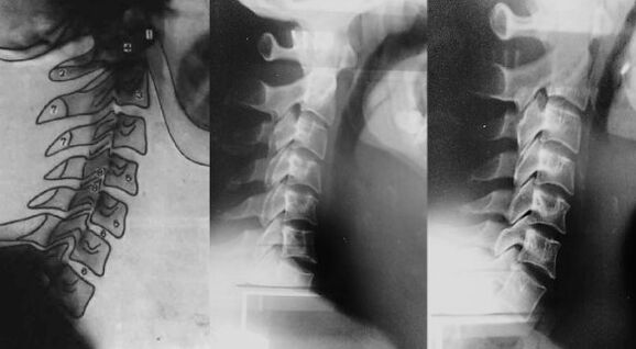 Neck with a first cervical vertebra shift