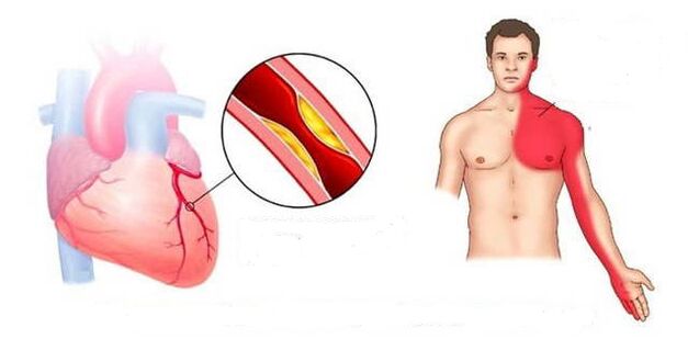Cardiac syndrome